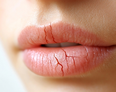 علل مختلف خشکی لب ها
